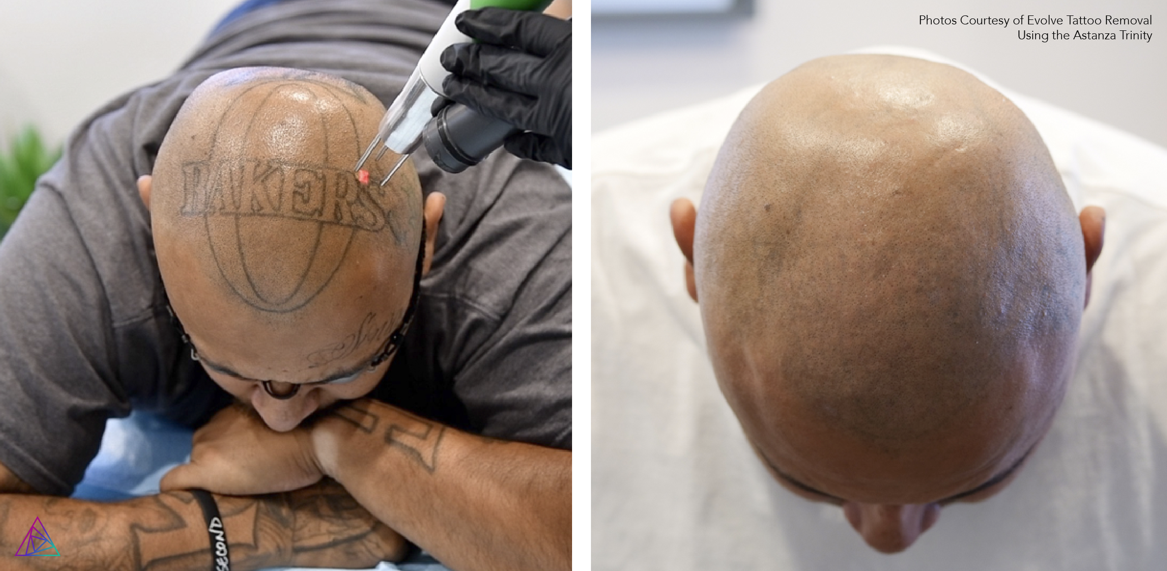 Before and after tattoo removal
